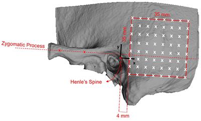 Quantitative Analysis of Temporal Bone Density and Thickness for Robotic Ear Surgery